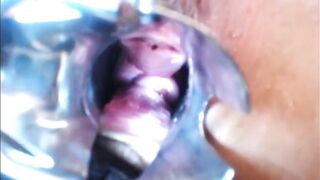 Speculum Cervix & Anal Exam Great View Inside